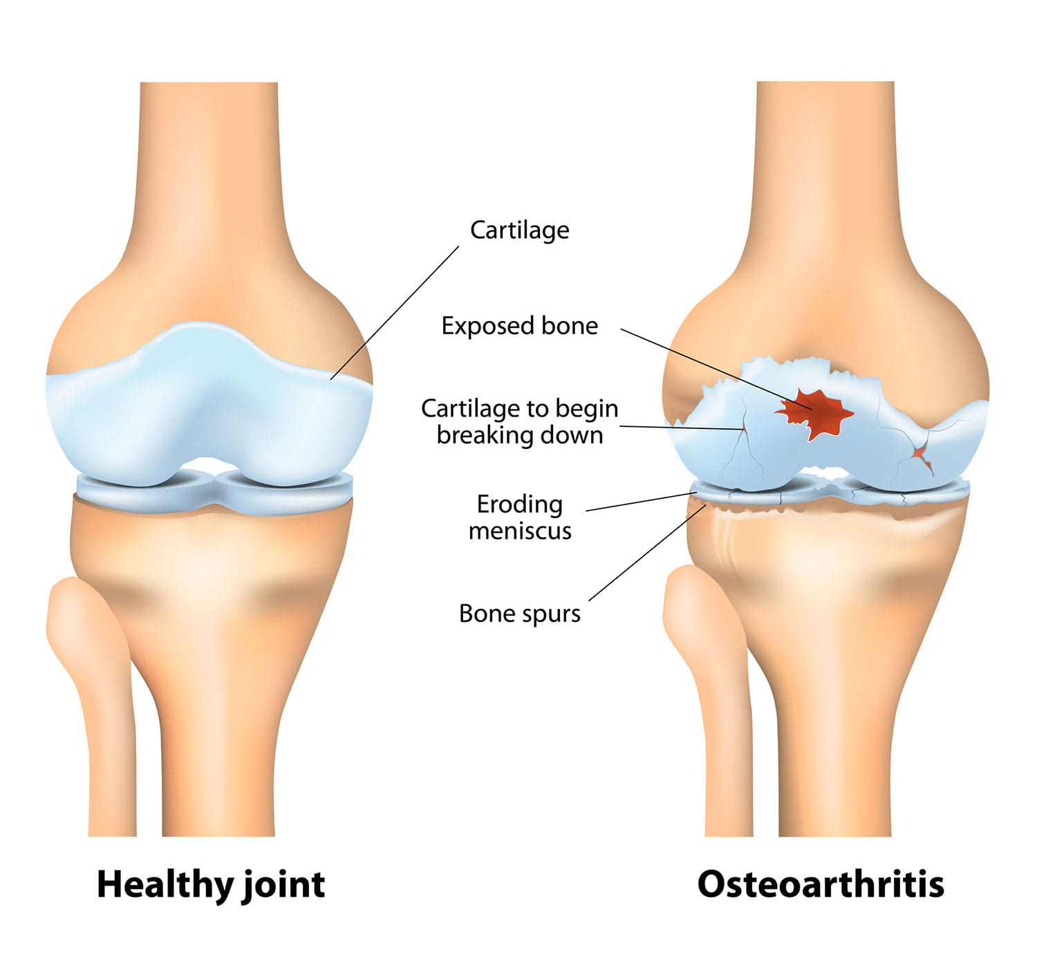 Health: Things to know about Osteoarthritis.